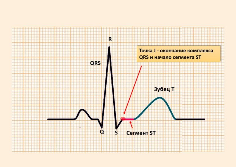 Элевации сегмента St на ЭКГ