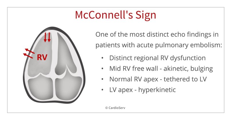 Acute Pulmonary Embolism