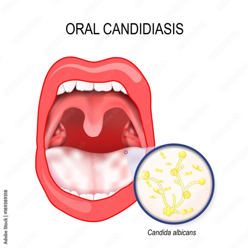 Кандидоз слизистой оболочки полости рта