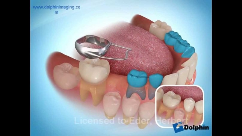 Кольцо с распоркой для зубов